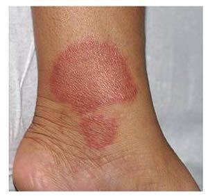 Hanseníase Transmitida pelo bacilo de Hansen (Mycobacterium leprae), causa lesões na pele, nas mucosas e nos