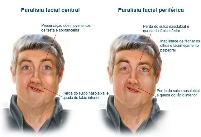 Paralisia Facial Perda dos movimentos da