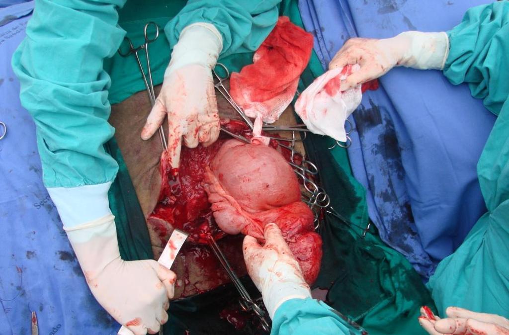 4 Figura 2. Redução cirúrgica do defeito adquirido na parede abdominal esquerda. Ápice do ceco encarcerado na lesão.