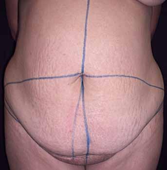 método de pinçamento da pele pubiana. As cicatrizes são colocadas o mais baixo possível no abdome.