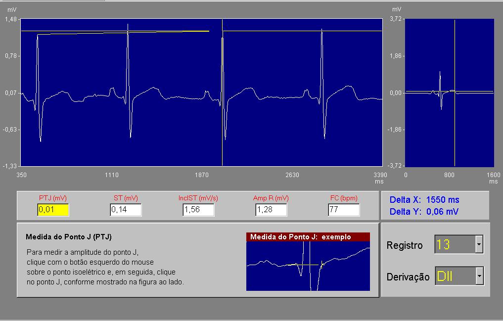 Medindo a Frequência Cardíaca Para medir frequência Cardíaca a partir do traçado, clique com o botão direito do mouse sobre a onda R e mova o cursor até o pico da segunda onda R