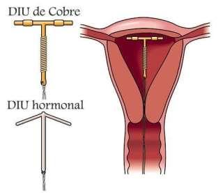 D - ESPERMICIDAS Existem dúvidas sobre os componentes de alguns espermicidas, que são absorvidos pelas paredes vaginais, com passagem para o leite materno e para o bebê.