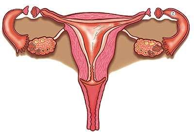 3. Que se ocorrer uma gravidez em presença de um DIU, mesmo que a mulher deseje levar a gravidez a termo, deve procurar cuidado médico. O dispositivo deve ser removido imediatamente, se possível.