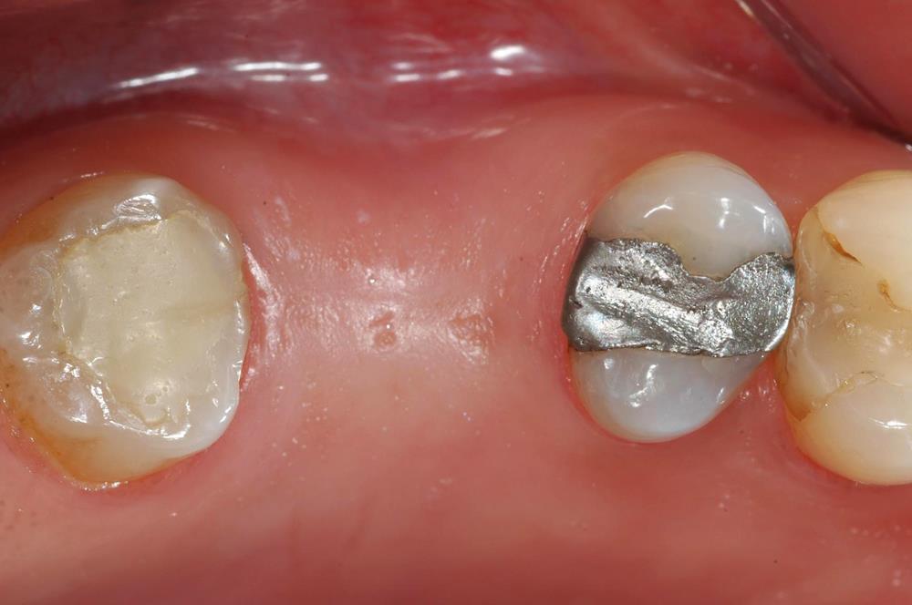 459 Fig. 1 - Aspecto intra-oral. Na análise radiográfica constatou-se ocorrência de pneumatização do seio maxilar com presença de dois septos incompletos, restando altura óssea de 4 mm (Fig.