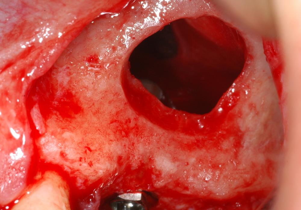 461 Fig. 6 - Acesso ao seio maxilar finalizado. Descolamento da membrana com curetas específicas.
