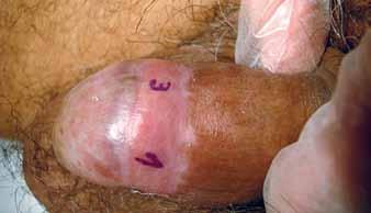 Foi efectuado tratamento em toda a lesão com 2-3mm de margem proximal e distal, por forma a envolver possíveis áreas subclínicas.