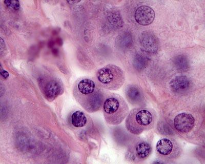 Células do tecido conjuntivo Plasmócito Diversos mecanismos de defesa dependem das células e dos elementos intercelulares do conjuntivo contêm células fagocitárias (macrófagos) e células produtoras