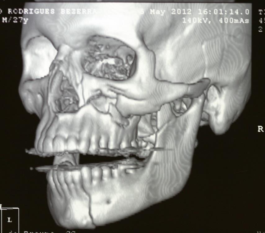 14 correção de defeito estético causado por trauma grave em região zigomáticoorbitária, utilizando a prototipagem para o planejamento e otimização cirúrgica.