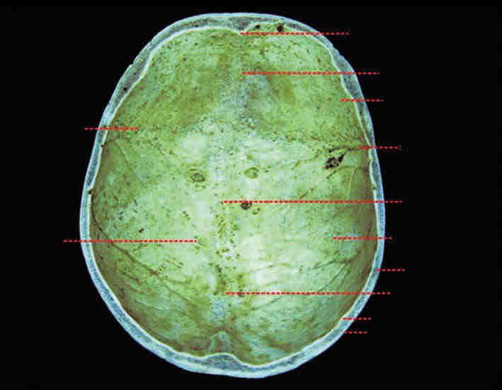 54 Neuroanatomia Clínica e Funcional: Anatomia, Fisiologia e Patologia BASE Ao examinarmos a base craniana verificamos a presença de três fossas ( Fig. 3.