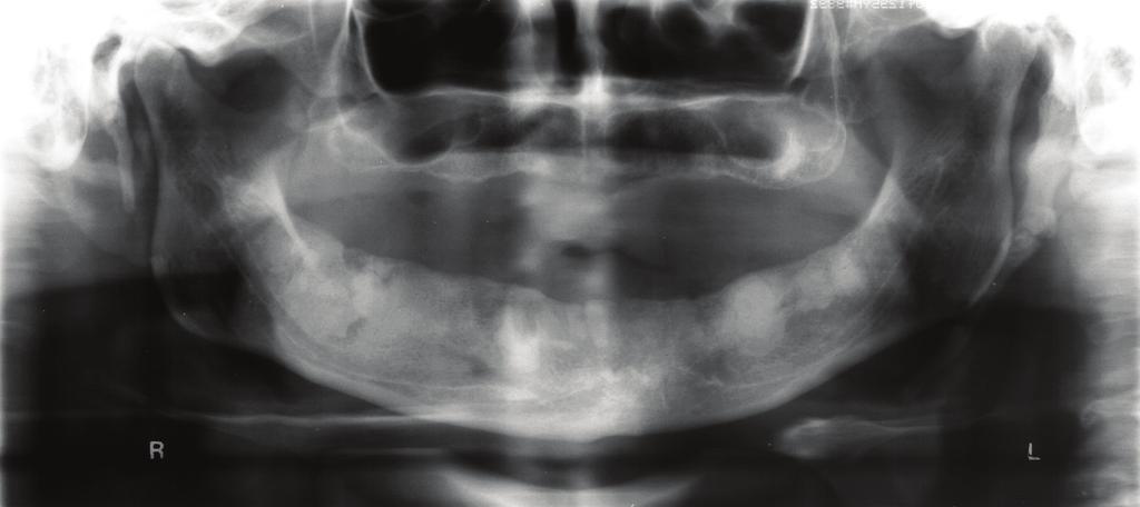 Ainda ao exame físico intrabucal, na região mandibular se observava edema e um ponto de consistência endurecida compatível com espícula óssea, recoberta por mucosa rósea de aspecto normal, na região