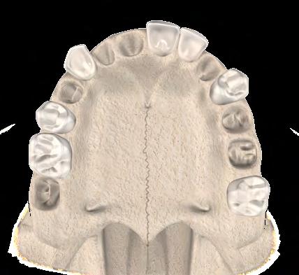 Na porção lateral da face anterior, logo abaixo da margem da órbita, aparece uma abertura, denominada forame infraorbital, por onde transitam vasos sanguíneos e nervos.