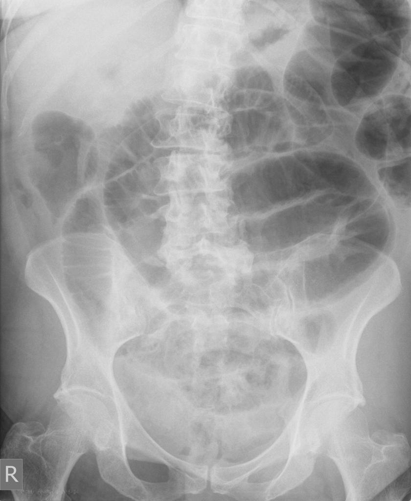 ESTAÇÃO 4 (Valor = 6,0 pontos) Paciente do sexo feminino, 55 anos, queixa-se de dor abdominal difusa e distensão abdominal. Realizada radiografia do abdome (imagem na tela).