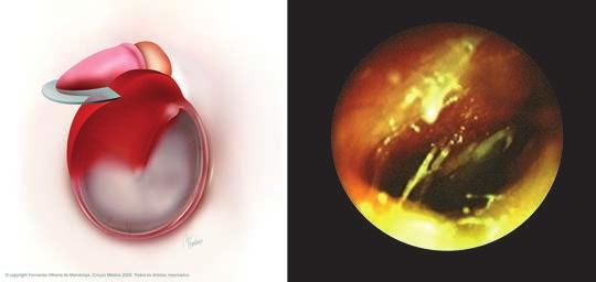 244 XI Manual de OtOrrInOlarIngOlOgIa PedIátrIca da IaPO Figura 8 Imagem otoscópica de uma criança com uma semana de idade e 38 semanas de gestação.