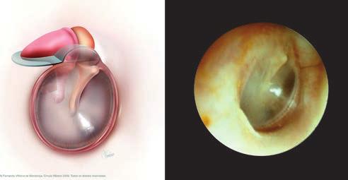 XI Manual de OtOrrInOlarIngOlOgIa PedIátrIca da IaPO 245 Figura 11 Imagem otoscópica de uma criança com 10 meses de idade.