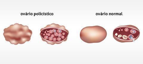 em excesso. A portadora da síndrome ovula com menor frequência e tem ciclos, em geral, irregulares (SOGESP, 2014).