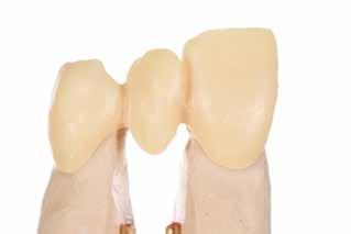 (Se o núcleo em uma área específica estiver abaixo da espessura mínima recomendada para a estrutura, a porcelana de dentina não deve ser