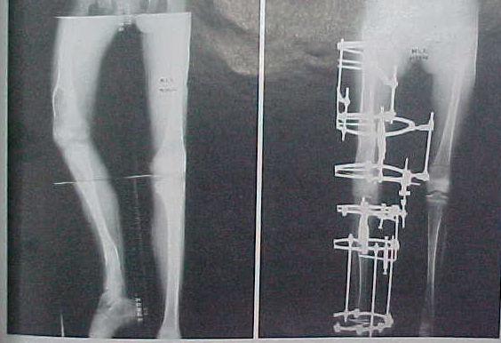 Pacientes que não querem ou estão impossibilitados de seguir as instruções pós-operatórias devido às condições que apresentam (mental ou física).