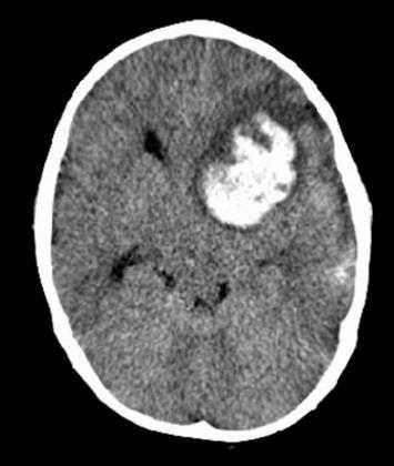 AVC hemorrágico em idade pediátrica CLINICA cefaleia, vómitos, alteração do estado de consciência,