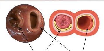 DISSECÇÃO Espontânea Traumática Doenças do tecido