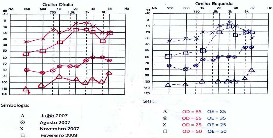 Na imitância acústica foram encontrados os seguintes resultados: curva timpanométrica do tipo A com reflexos ipsilaterais e contralaterais ausentes bilateralmente.