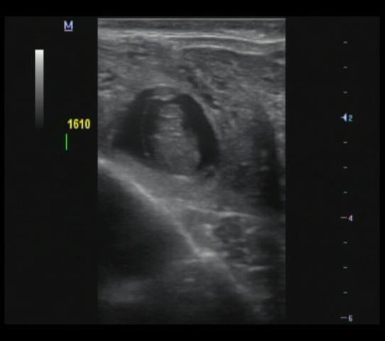 o embrião e, em geral, (ou logo a seguir) no outro corno uterino.