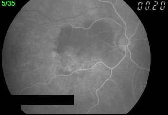 A B C D Figura 11 Angiografia fluoresceínica do OD nos