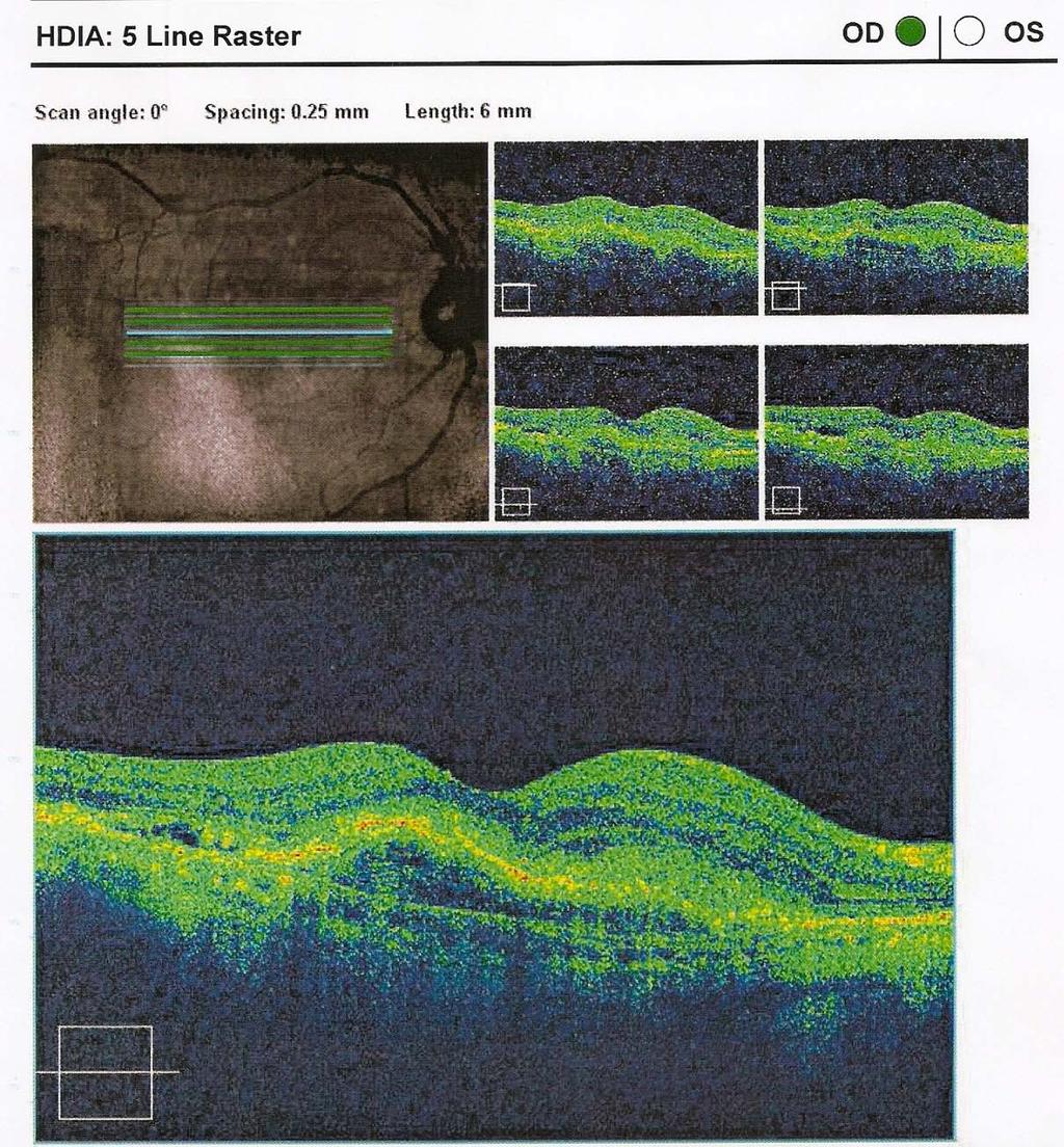 Realizou-se também o OCT com o aparelho Zeiss (Cirrus HD-OCT), no qual são efectuadas várias análises às camadas da retina com programas centrados à mácula.