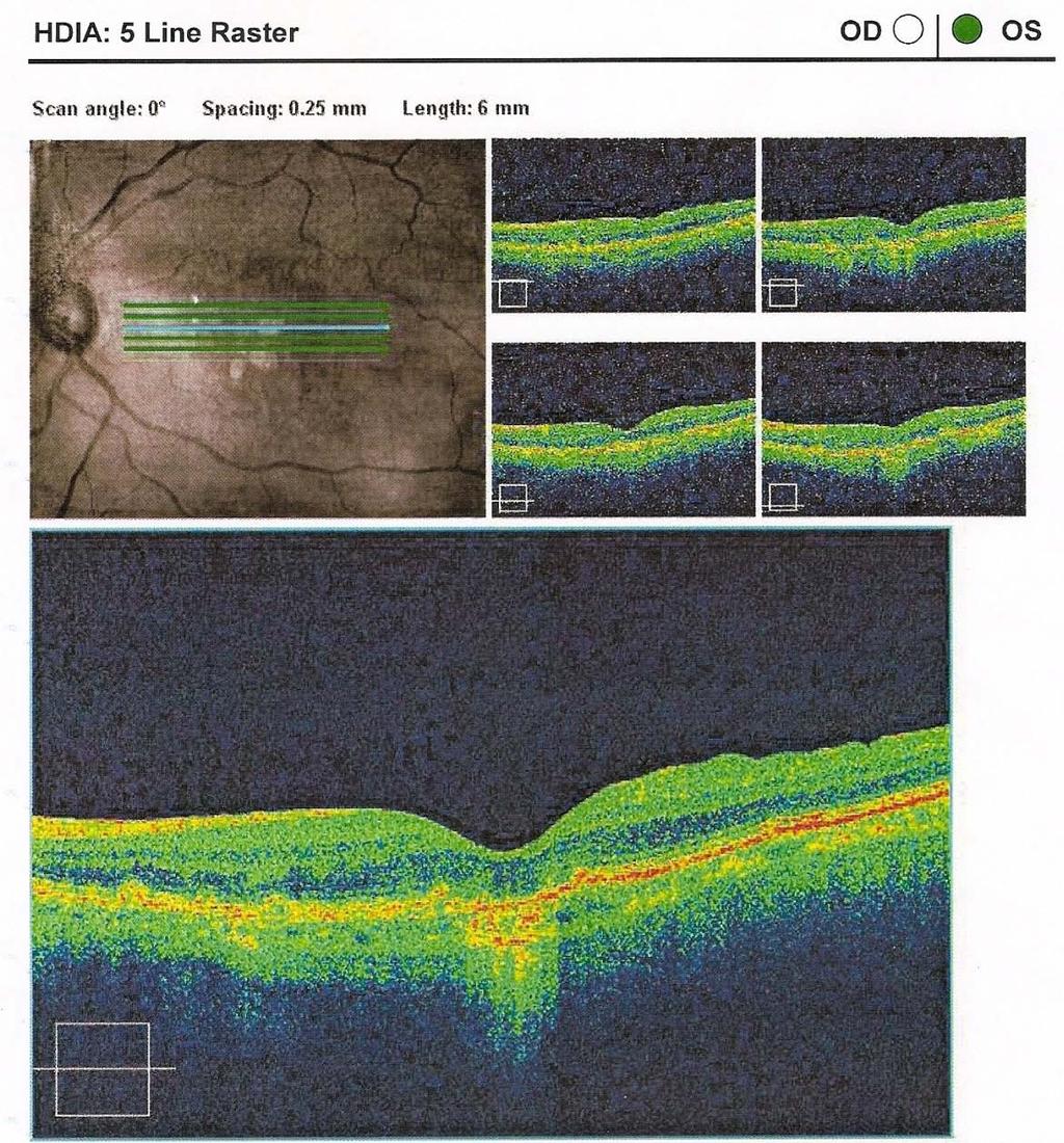 Figura 15 Imagens tomográficas do olho esquerdo da retina, a partir de 5 cortes paralelos com espaçamento de
