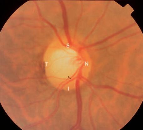 Avaliação clínica Escavação grande com distribuição normal rima neurorretiniana.