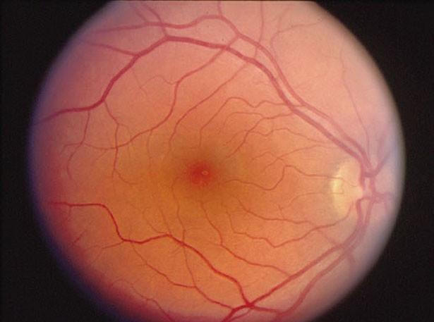 A retina