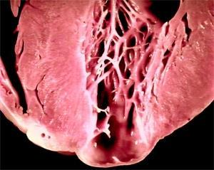 Doença de Chagas - Patologia Fase crônica cardíaca: miocardiopatia inflamatória fibrosante, essencialmente arrítmica, que