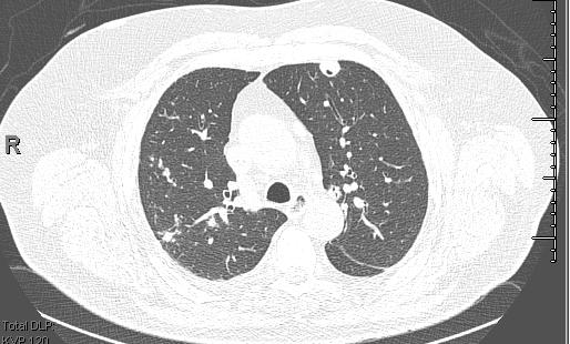 Complicações: Pneumotorax, derrame pleural, fístula broncopleural Podem cavitar Turesson C et al.