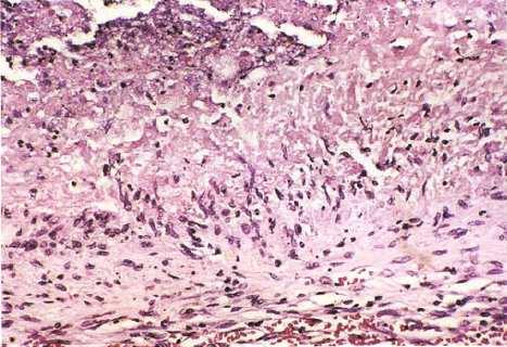 Histologia Clássica Não é patognomônica Nódulo com necrose central e paliçada de histiócitos, podendo conter células gigantes esparsas Vasculite (não necrotizante) Céls gigantes Evolução do caso