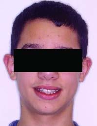 faciais, competência labial e linha de sorriso normal. As linhas médias maxilar e mandibular em relação à linha média da face mostravam-se centradas.