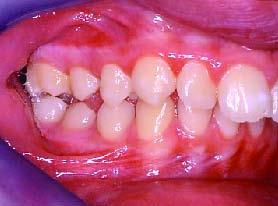 Do ponto de vista dentário mostrava relação molar e canina de Classe II direita e esquerda; mesialização e rotação de ambos os molares superiores, sendo