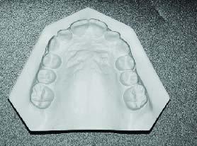 sulco mento-labial pronunciado, o que está de acordo com o biótipo facial do paciente (fig. 1 e 4).