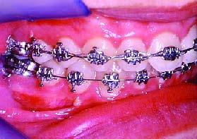 A fase de alinhamento e nivelamento coronário dos dentes maxilares e mandibulares foi efectuada com arcos de níquel titânio 0,014 e posteriormente 0,016 mais tarde substituídos por arcos em aço