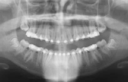Pinho T Figura 7 - Radiografia panorâmica de controlo (antes do nivelamento dos segundos molares) Procedeu-se à extracção do dente supranumerário e à recolocação dos brackets do 22, 41 e 43, mudando