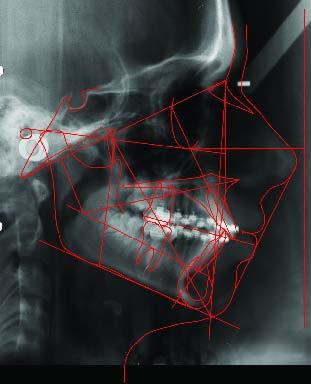 Três meses antes de terminar a correcção, para melhorar a intercuspidação inter-arcadas foram apenas usados dois elásticos de menor calibre (4,8 mm) desde o 12-13 ao 43-44 e do 22-23 ao 33-34.