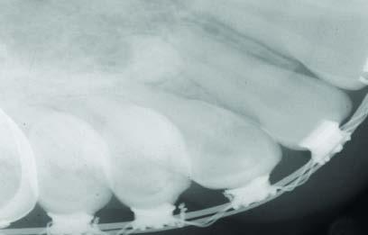 Classe II, Divisão I, Tratada sem Extracções - Caso Clínico Figura 9 - Rx periapical com um dente supranumerário em formação, ao