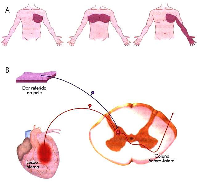 Dor referida Irritação visceral geralmente