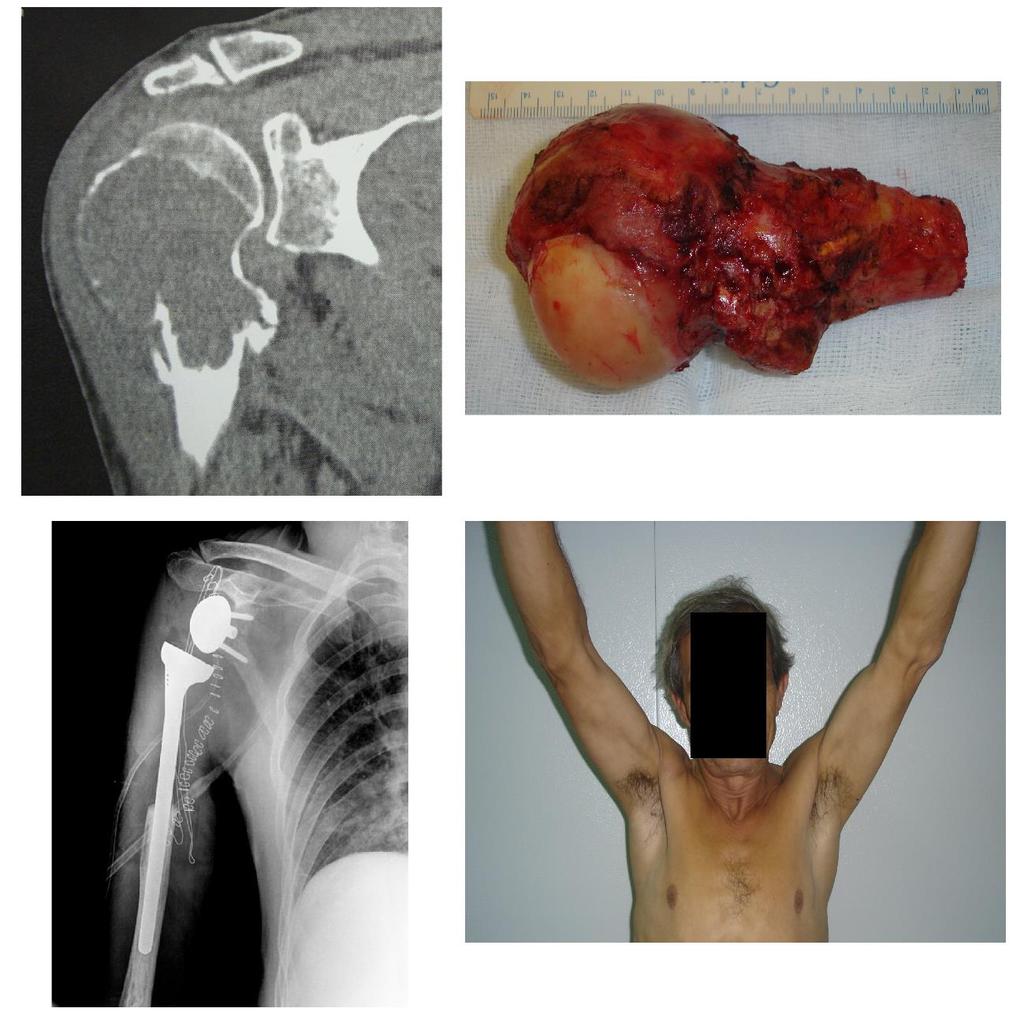 foi realizado com enxerto autólogo em 2 dos casos, de localização no calcâneo, e com cimento nos demais. Um doente foi submetido a terapia com Denosumab antes de ser submetido a intervenção local.