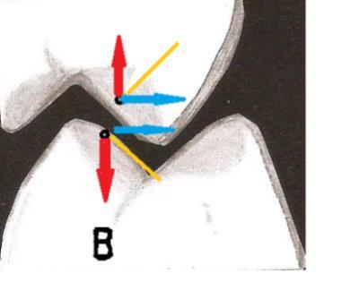 30 projeção dos dentes superiores. No arco inferior pode levar ao desvio mandibular, gerando mordida cruzada funcional ou contatos horizontais fortes do outro lado do arco.
