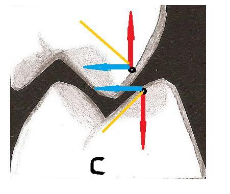 não contenção do dente inferior (lingual). fig 05- Dente molar inferior mostrando o contato C.