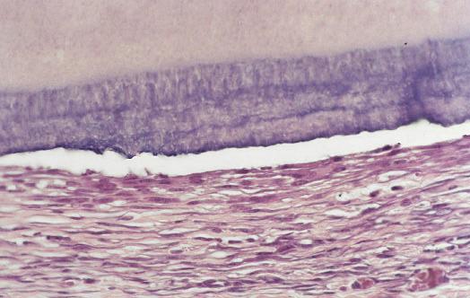 Resultados 82 FIGURA 24- Fotomicrografia da área adjacente à superfície radicular do grupo 4 (raspagem e alisamento radicular com cureta), 14 dias após a implantação.