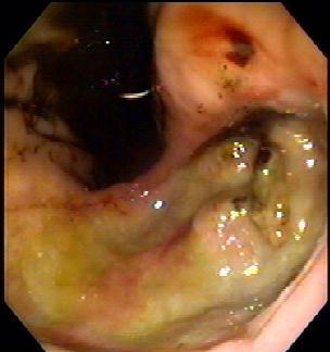 Limitações do tratamento endoscópico Úlcera gigante,