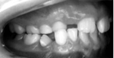 Embora as causas sejam as mais variadas possíveis 1,14 para explicar a transposição do germe dentário durante a odontogênese ou a migração do dente durante a sua irrupção, a genética 15, num modelo