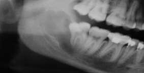 Através da aplicação do método de Miller-Winter foi possível observar que a lesão desenvolveu-se no sentido ântero-posterior, acometendo toda a porção medular do osso mandibular, sem ocasionar
