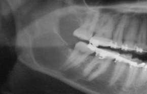 3 Caso 3 Paciente do gênero feminino, 19 anos de idade, foi encaminhada pelo ortodontista para análise de lesão mandibular.