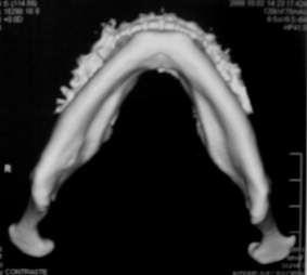 correspondente à lesão, sem sinais de erosão ou expansão panorâmica da tomografia computadorizada por feixe cônico